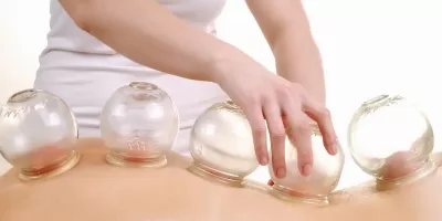 Cupping Therapy